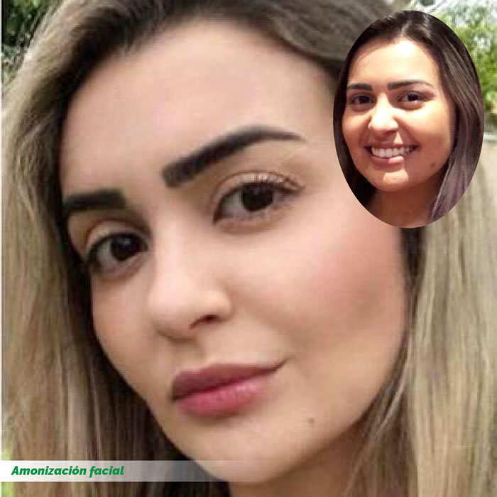 Rinoplastia Rinoplastia