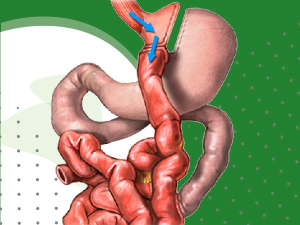 BYPASS GASTRICO
