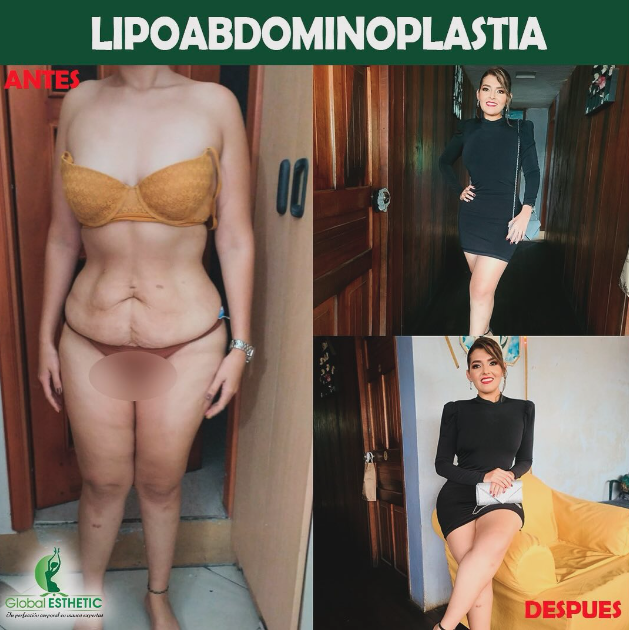 Asesoría para lipoescultura, rinoplastia, globalesthetic LIPOABDOMINOPLASTIA