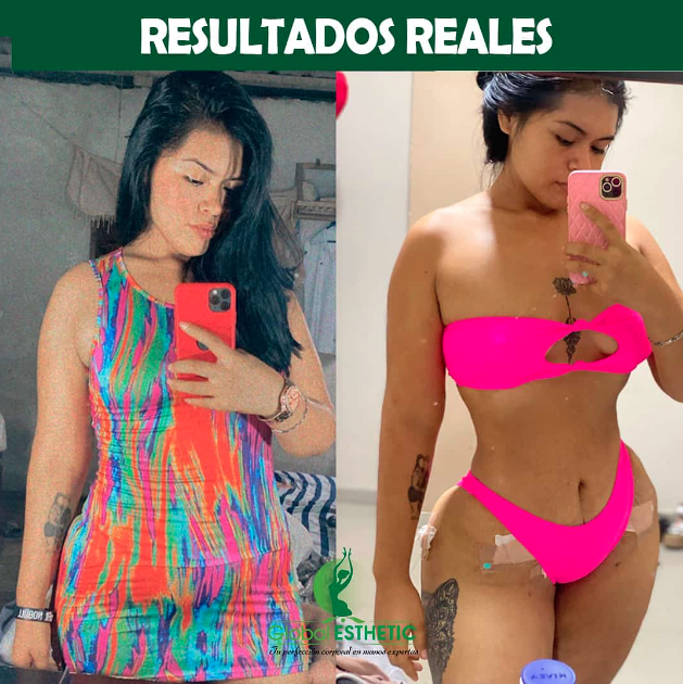 Asesoría para lipoescultura, rinoplastia, globalesthetic LIPOESCULTURA