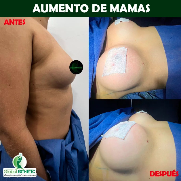 Asesoría para lipoescultura, rinoplastia, globalesthetic AUMENTO DE MAMA