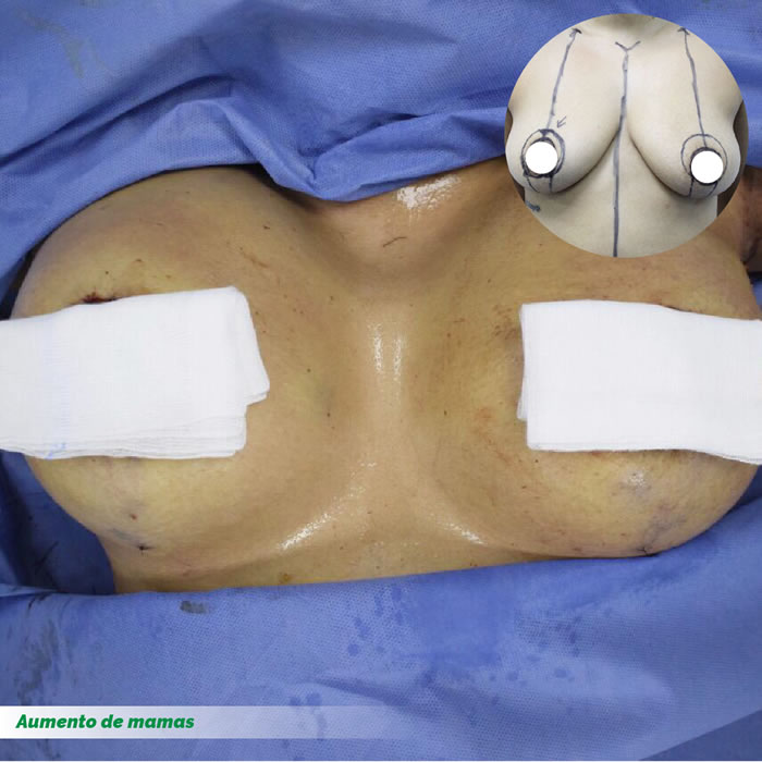 Levantamiento de mamas