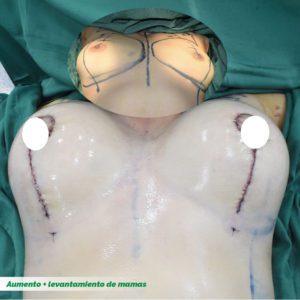 Levantamiento de mamas