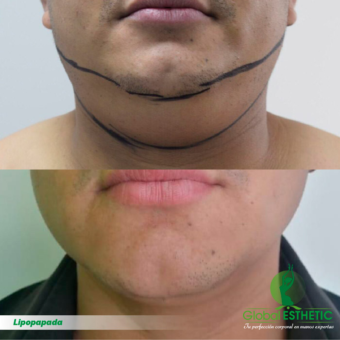 Lipopapada masculina