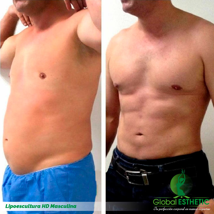 Lipoescultura masculina