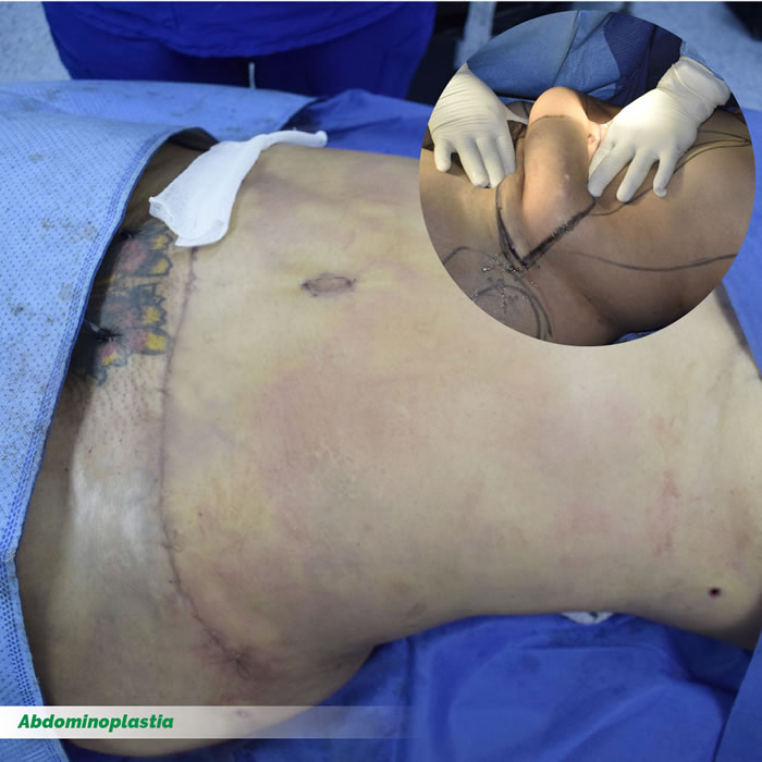 Abdominoplastia
