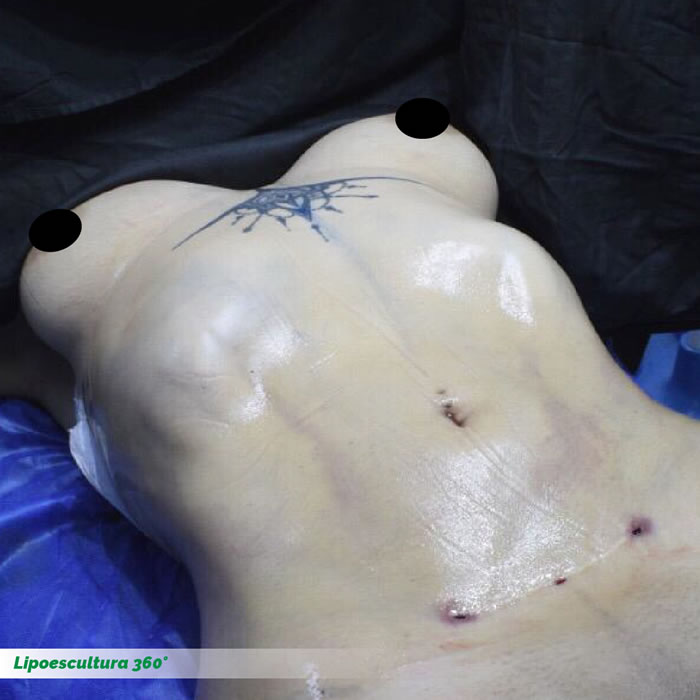 Lipoescultura HD