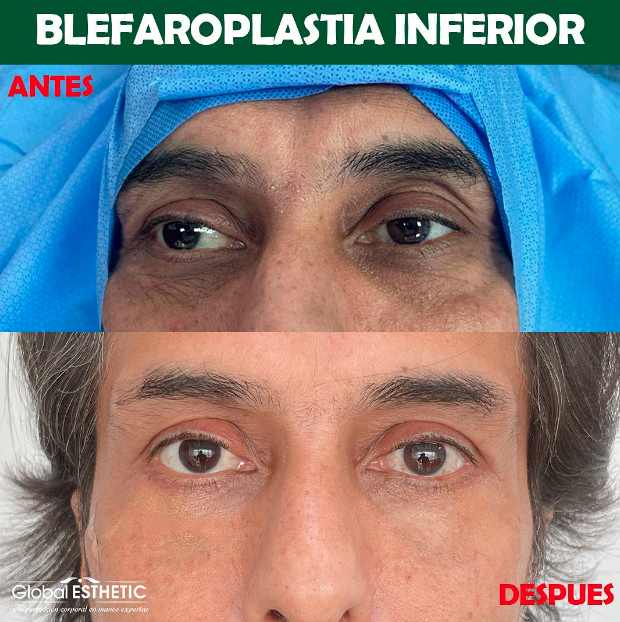 Asesoría para lipoescultura, rinoplastia, globalesthetic BLAFAROPLASTIA