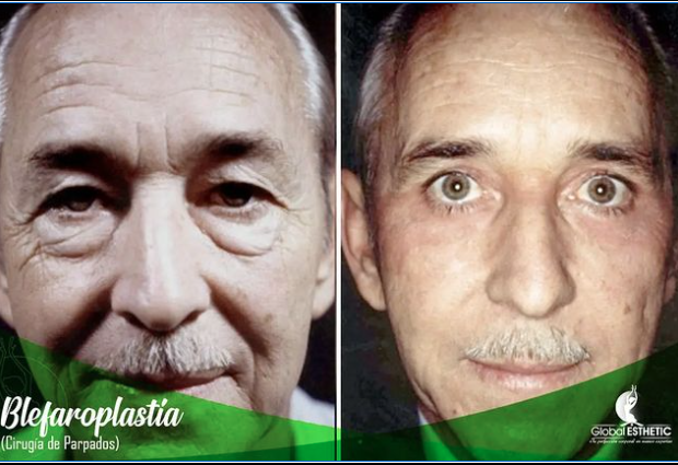 Blafaroplastia
