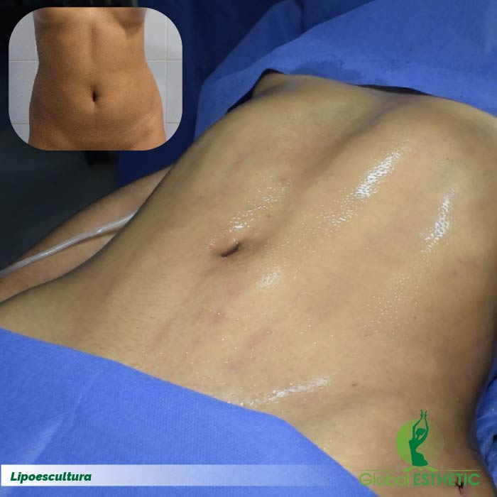 Lipoescultura