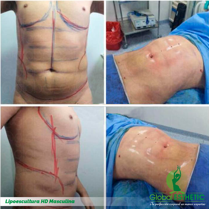 Lipo Masculina