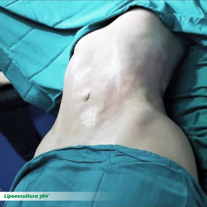 lipoesculturaHD6 LipoesculturaHD6