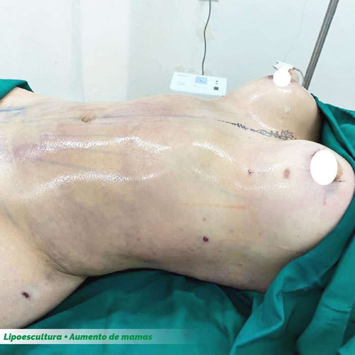 LipoesculturaHD7