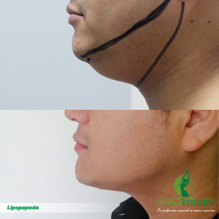 Lipopada