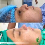 📆 Quito Sábado 11 octubre 2025 Cirugías Faciales Rinoplastia