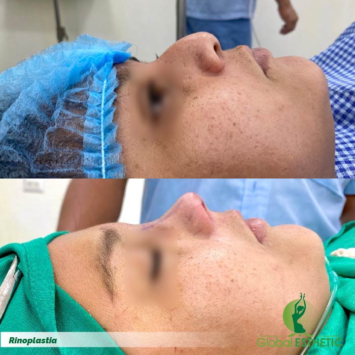 Rinoplastia