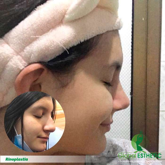 Rinoplastia Rinoplastia