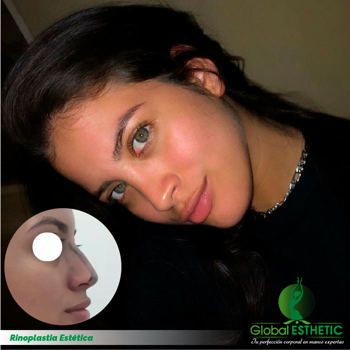 Rinoplastia