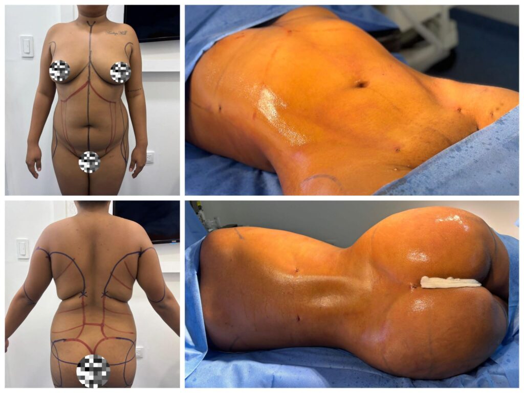 Resultado de Lipoescultura 4