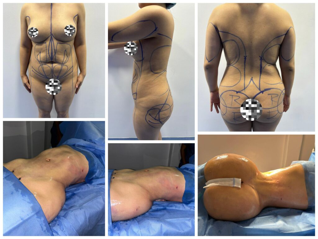 Resultado de Lipoescultura 2
