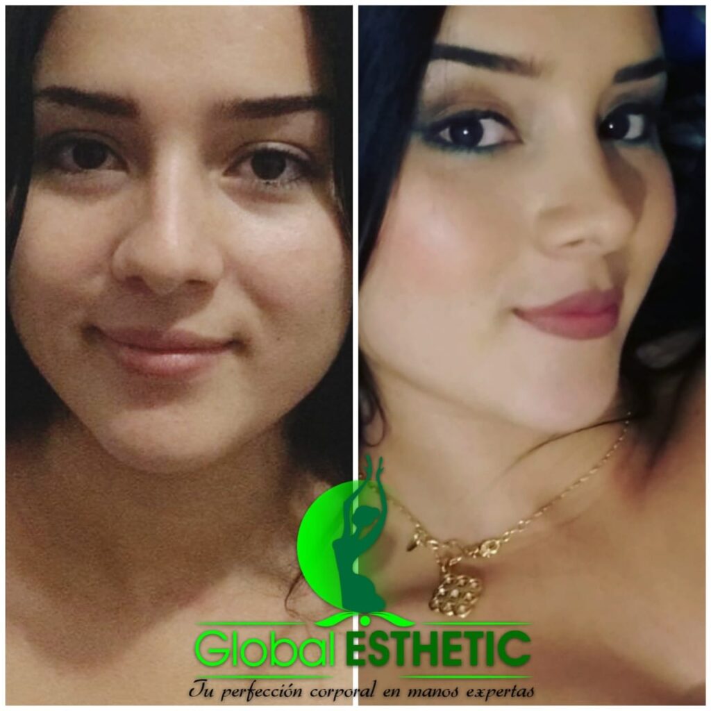 Armonización facial completa Armonización facial completa