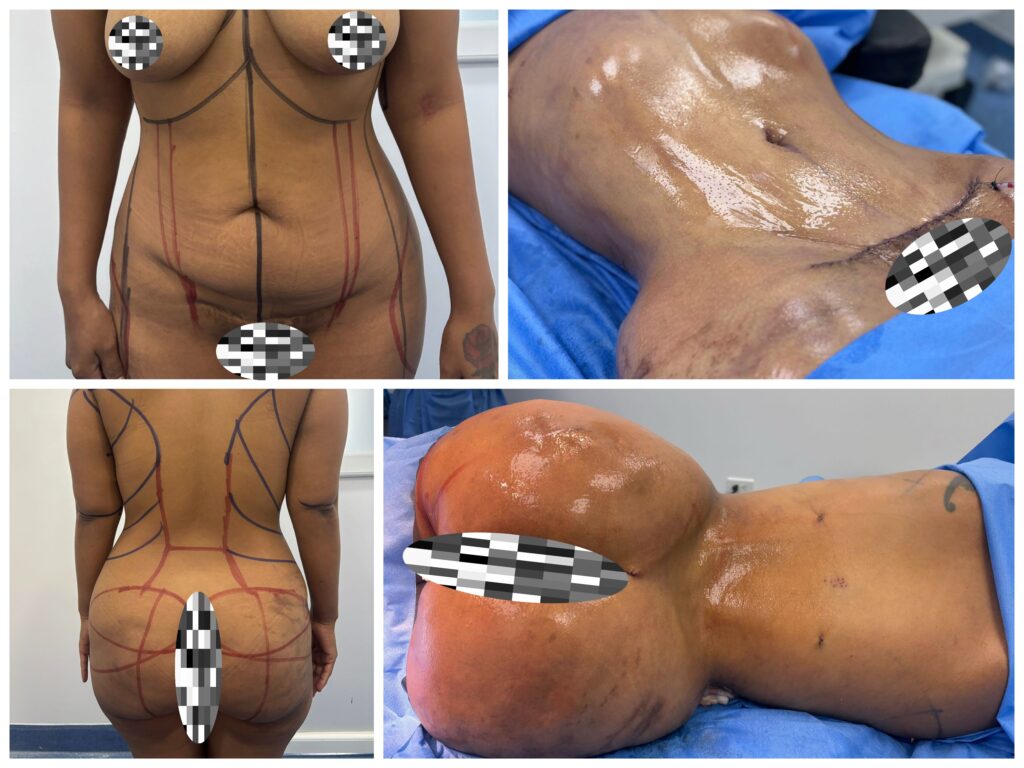 Miniabdominoplastia