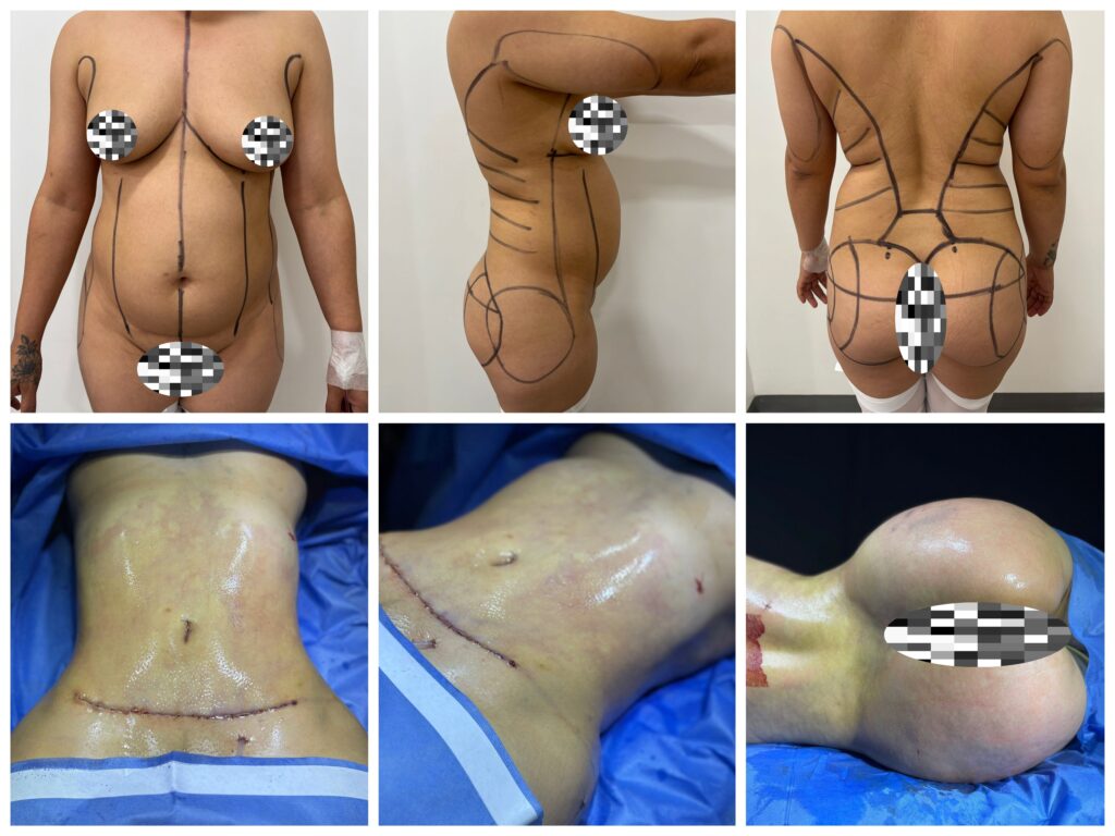 Miniabdominoplastia