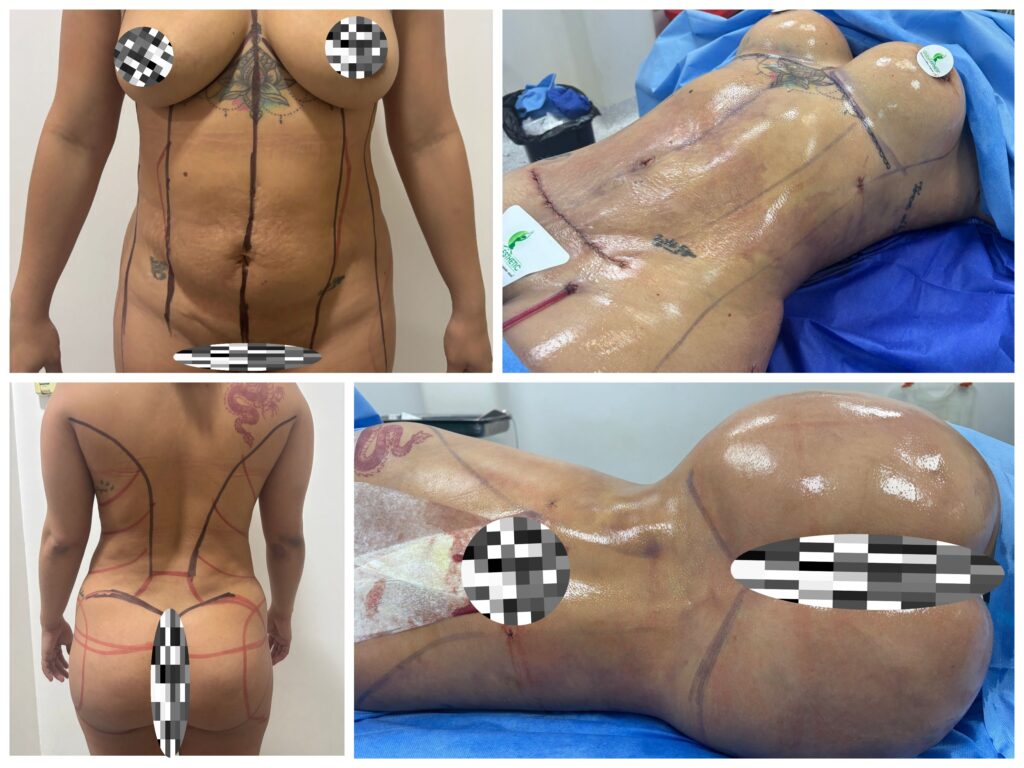 Miniabdominoplastia