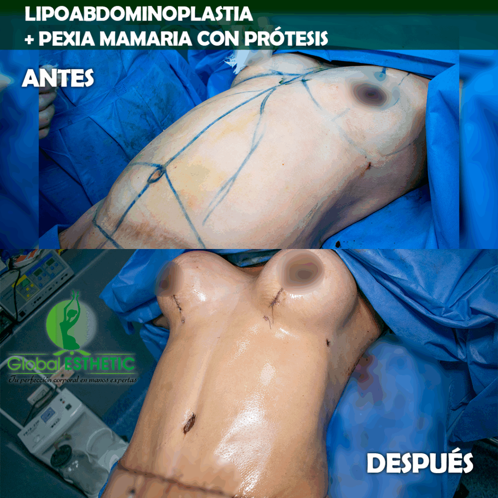 lipoabdominoplastia + pexia con protesis