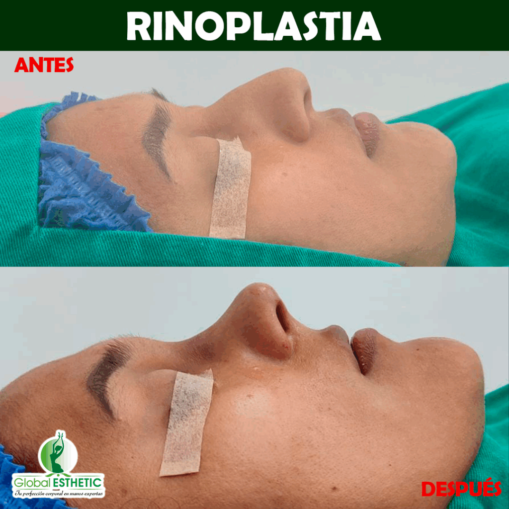 Rinoplastia
