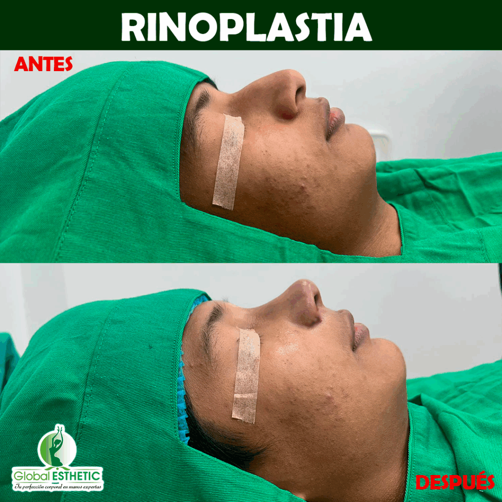 Rinoplastia