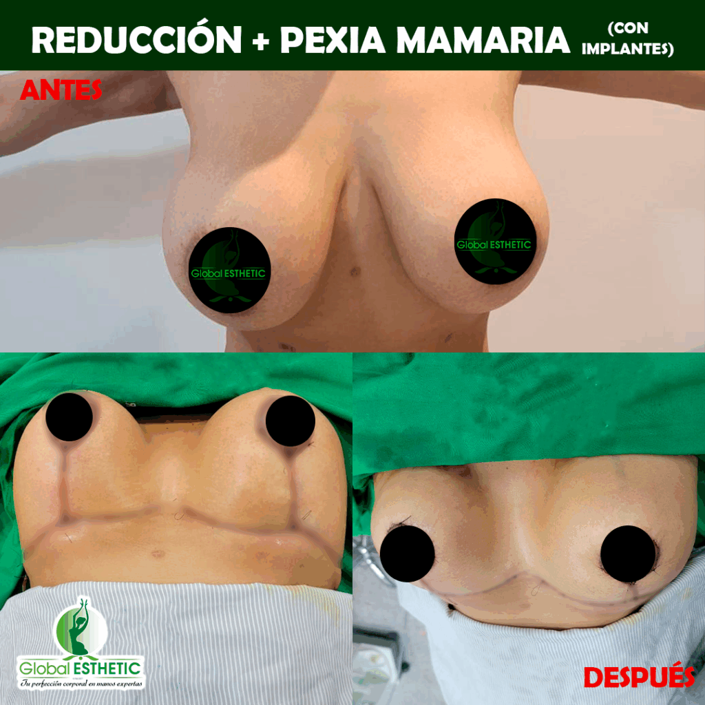 Reducción pexia mamaria