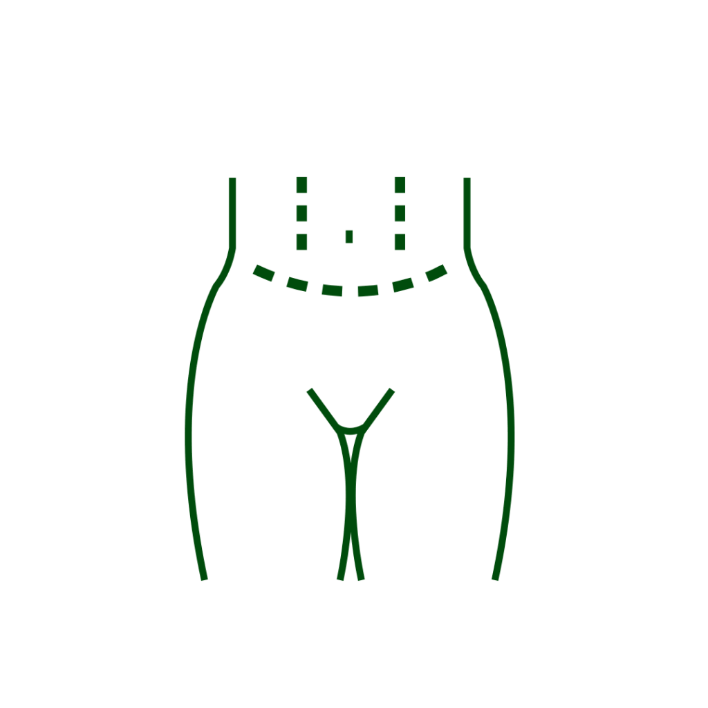 Abdominoplastia Abdominoplastia