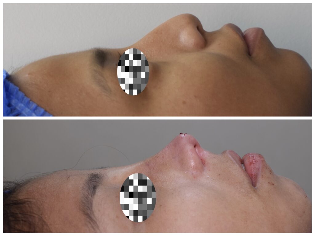 RINOPLASTIA