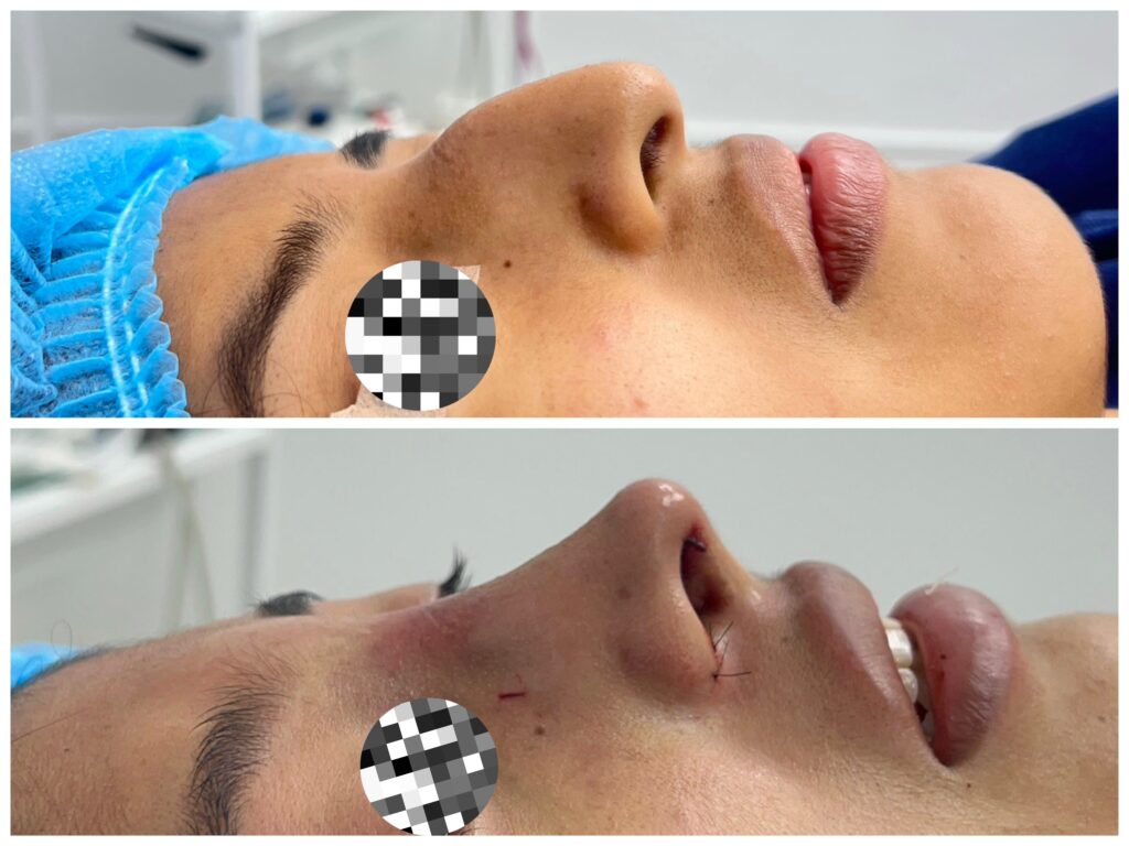 RINOPLASTIA