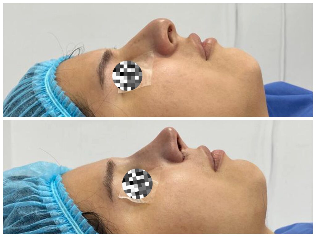 RINOPLASTIA