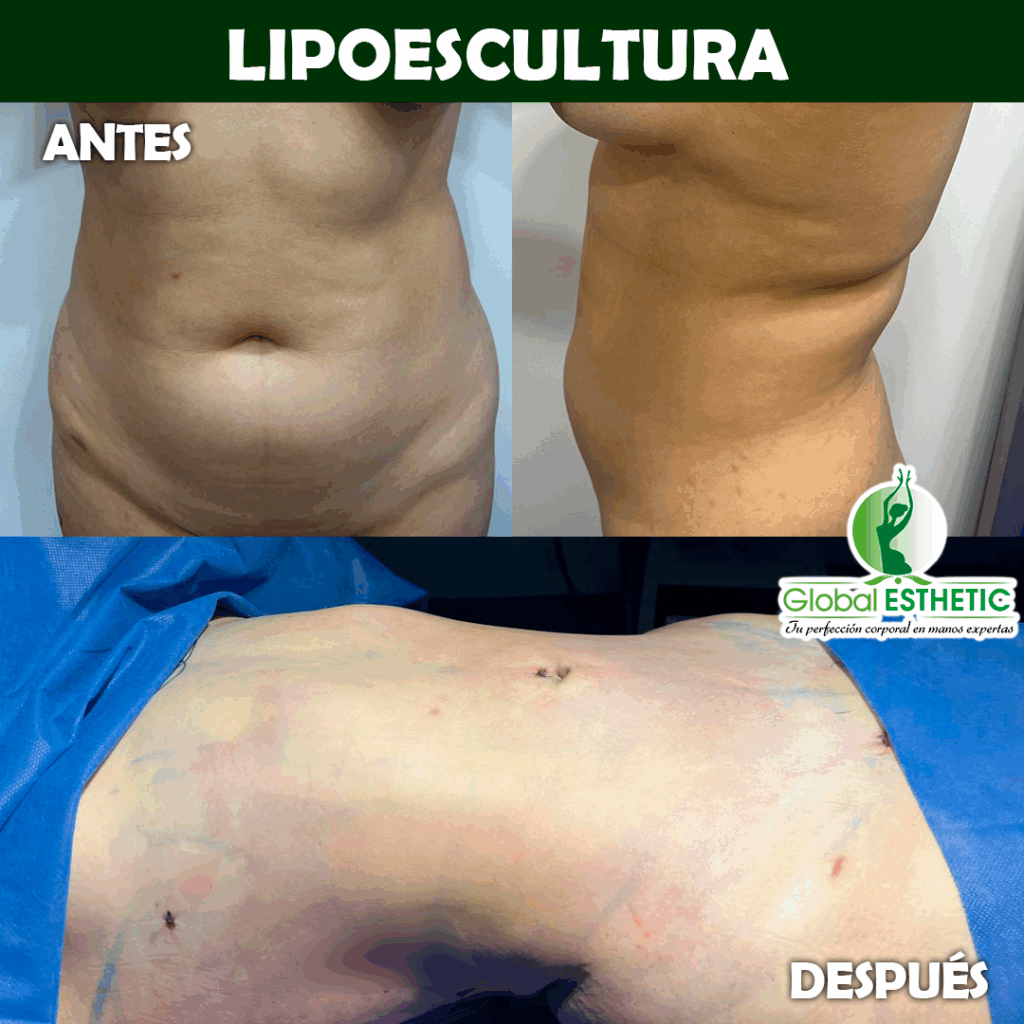lipoescultura 01